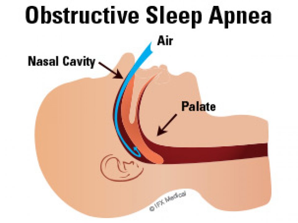 Sleep Apnea Treatment __Sunrise Dental | Chapel Hill | Durham | Raleigh | Cary, NC