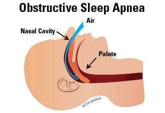 Sleep Apnea Treatment __Sunrise Dental | Chapel Hill | Durham | Raleigh | Cary, NC